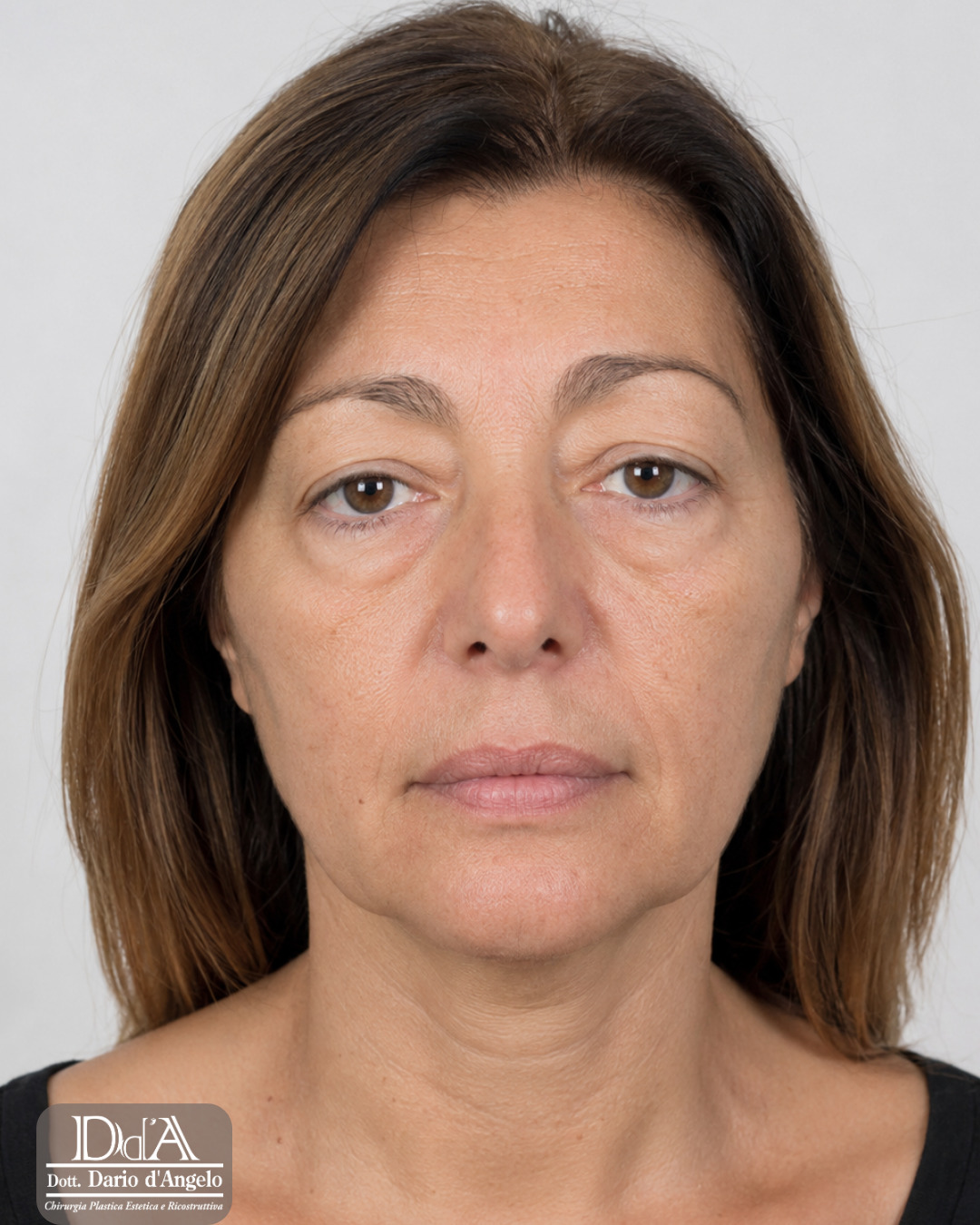 Prima - Chirurgia Oculopalpebrale